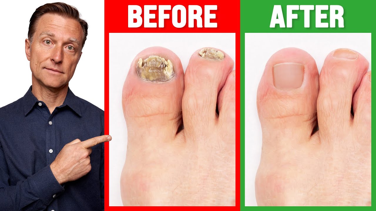 The REAL Cause of Toenail Fungus is …