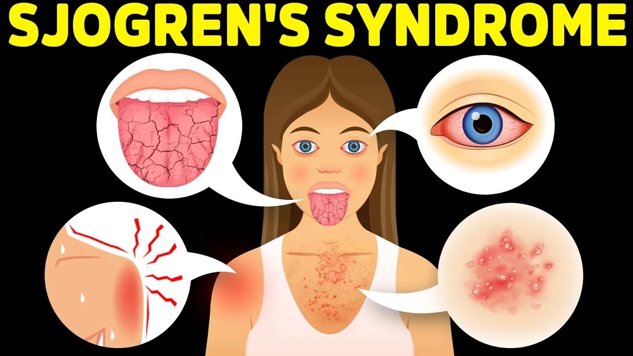 The Best Protocol for Sjogren’s Syndrome