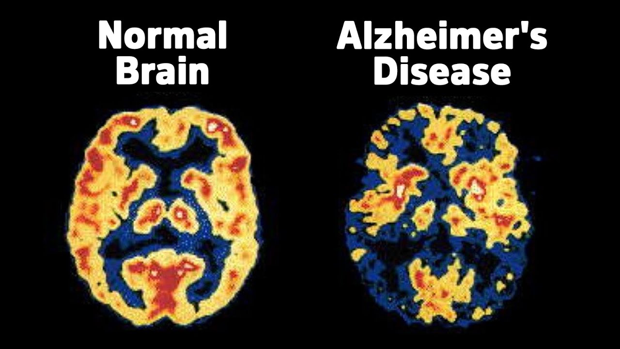 Groundbreaking New Revelations on Alzheimer’s Disease