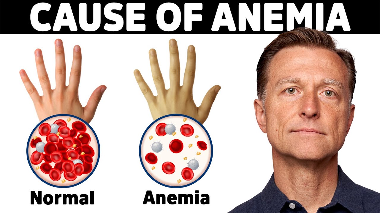 The Hidden Cause of Anemia You’ve Never Heard About