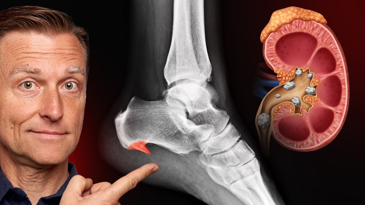 6 Reasons for Calcium Deposits (Spurs, Osteophytes, Stones, and Tartar)