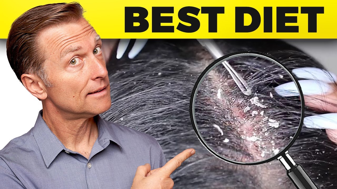 The #1 Best Diet for Dandruff