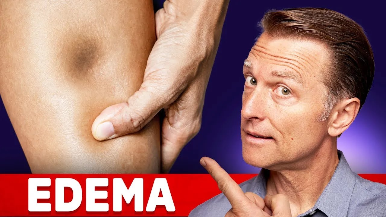 The 8 Causes of Edema