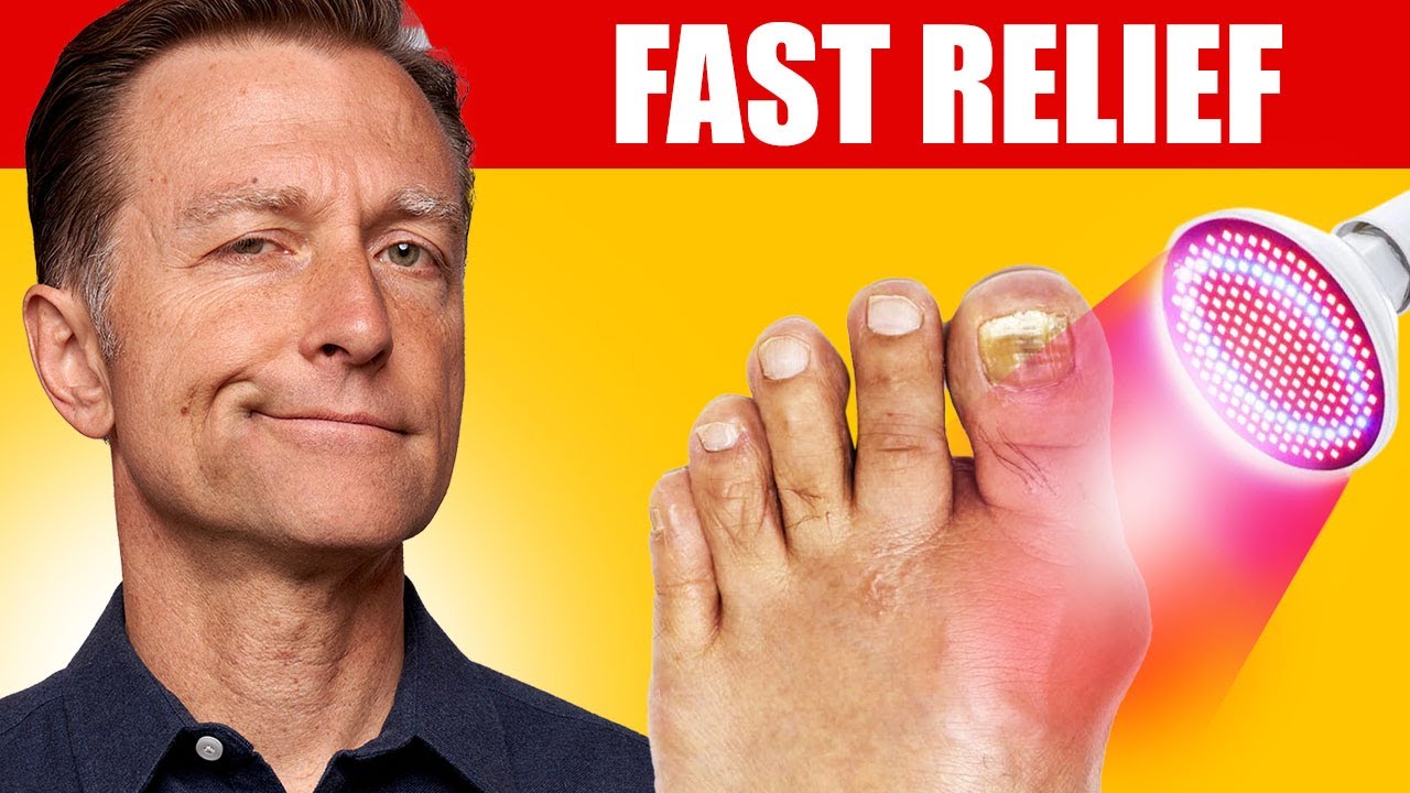 The Best Therapy for Gout (High Uric Acid)