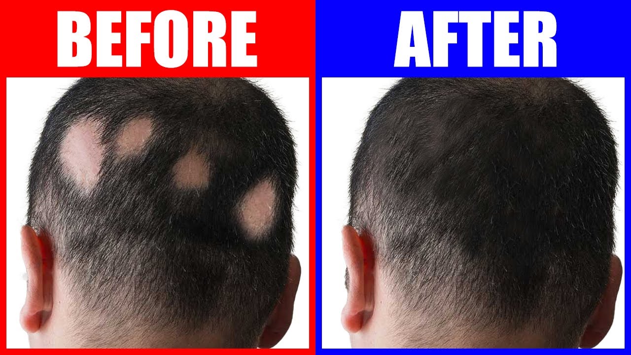 3 Trace Minerals to Reverse Alopecia