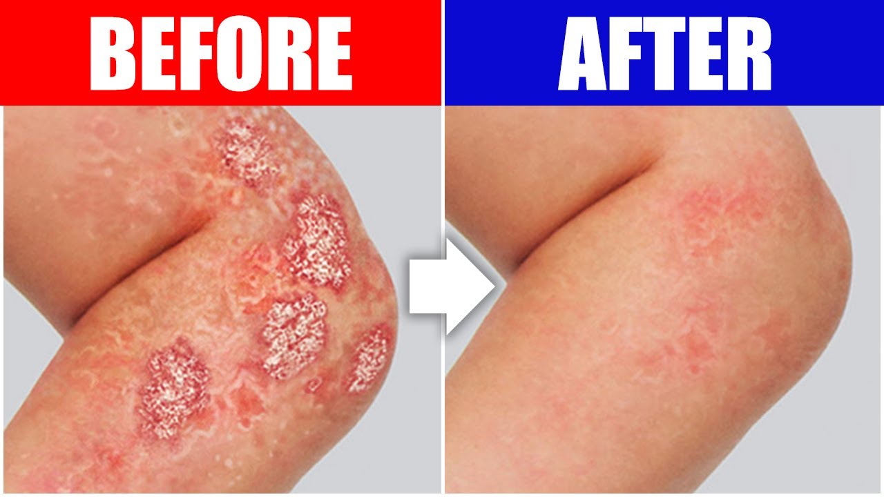 The #1 Remedy for Psoriasis