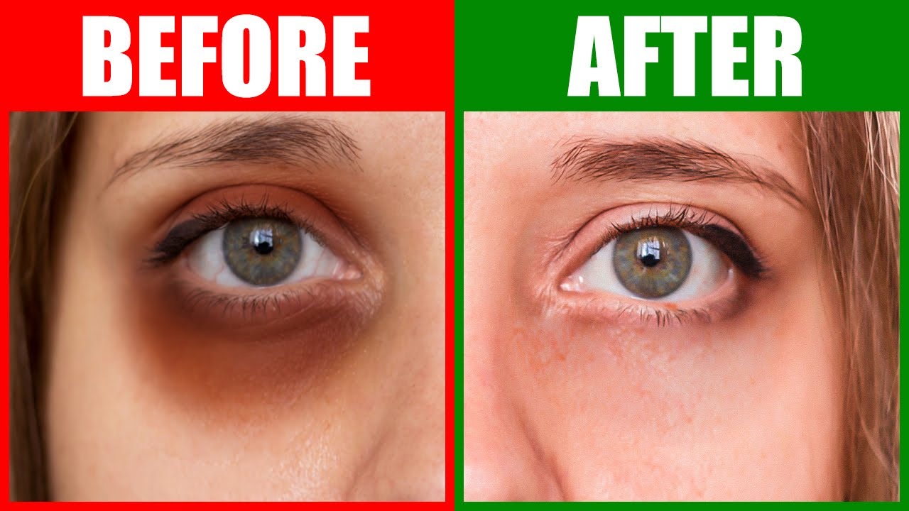 How To Rid Dark Circles Naturally in 24 Hours