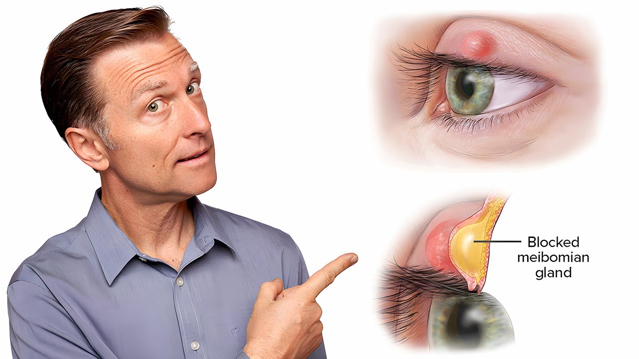 What Really Causes Styes and How to Get Rid of Them Fast