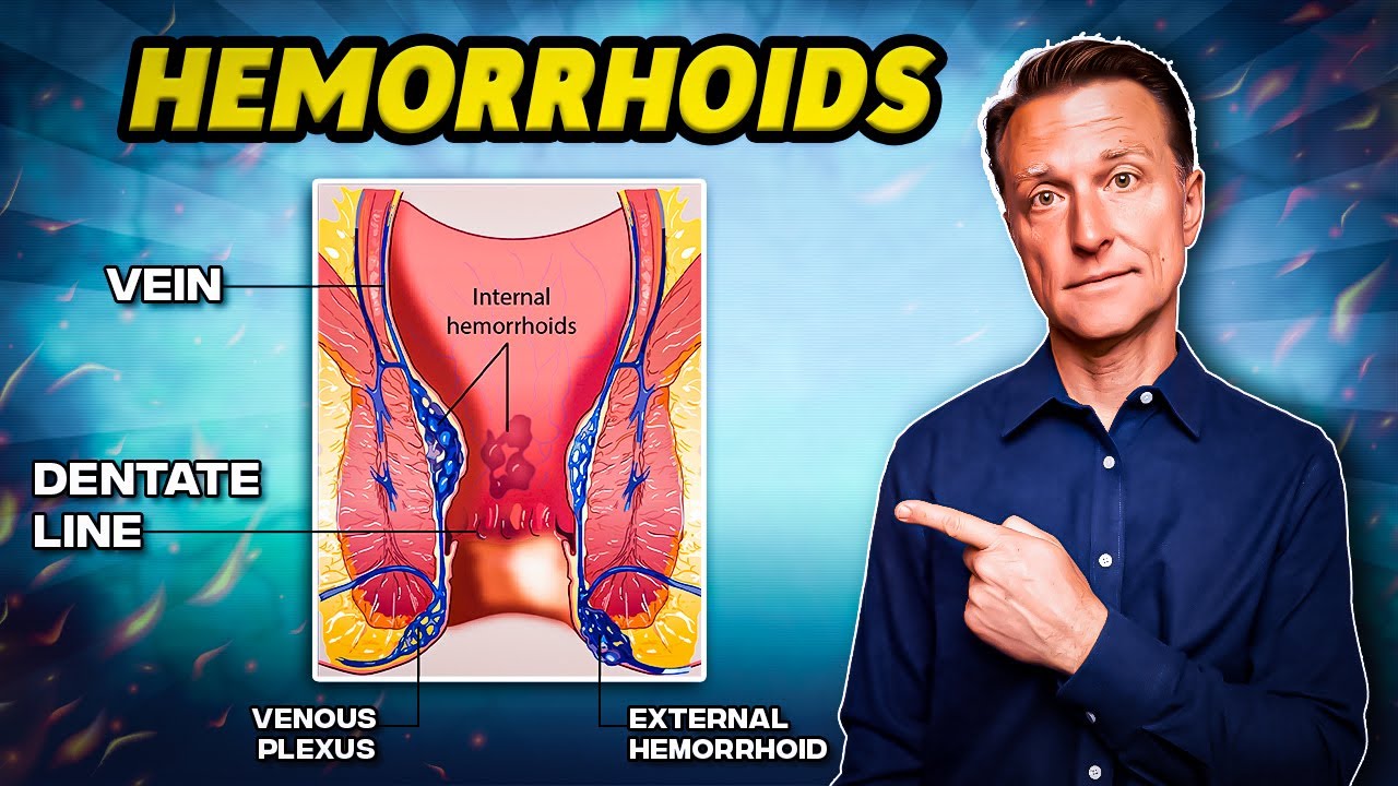 The #1 Best Remedy for Hemorrhoids – Dr. Berg