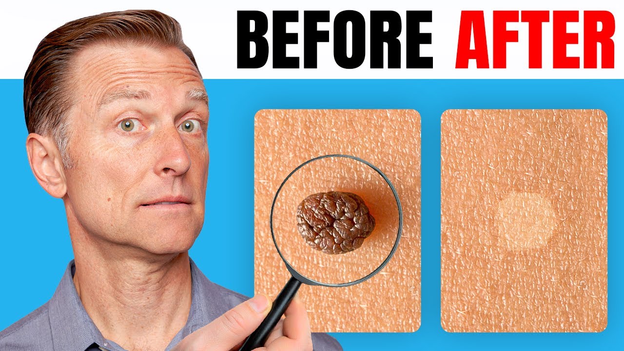 How to Remove Skin Tags and Warts Overnight – Dr. Berg Explains