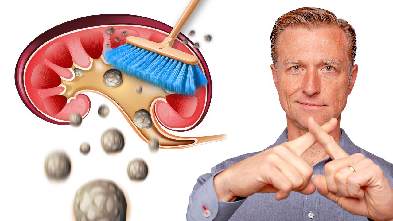 Clean Out Your Kidneys of Oxalates and Stones – Dr. Berg