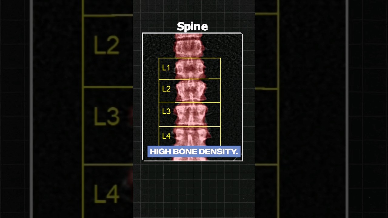 How I Got Extraordinarily High Bone Density