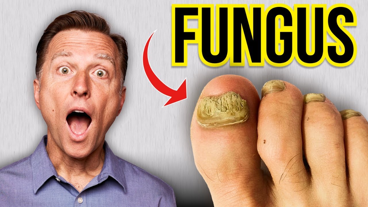 How to Get Rid of Toenail Fungus Fast!